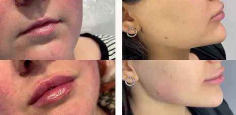 l after treatment