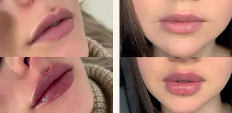 m after treatment