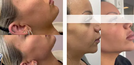 xl after treatment